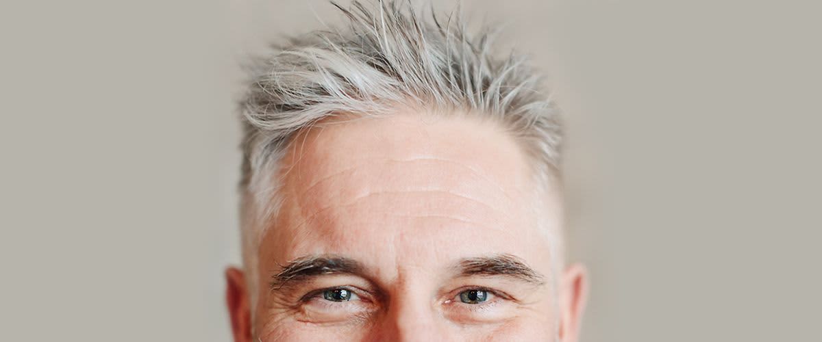 Sijeda kosa kod muškaraca