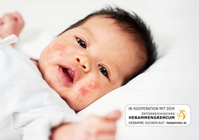 Baby mit roten Flecken im Gesicht