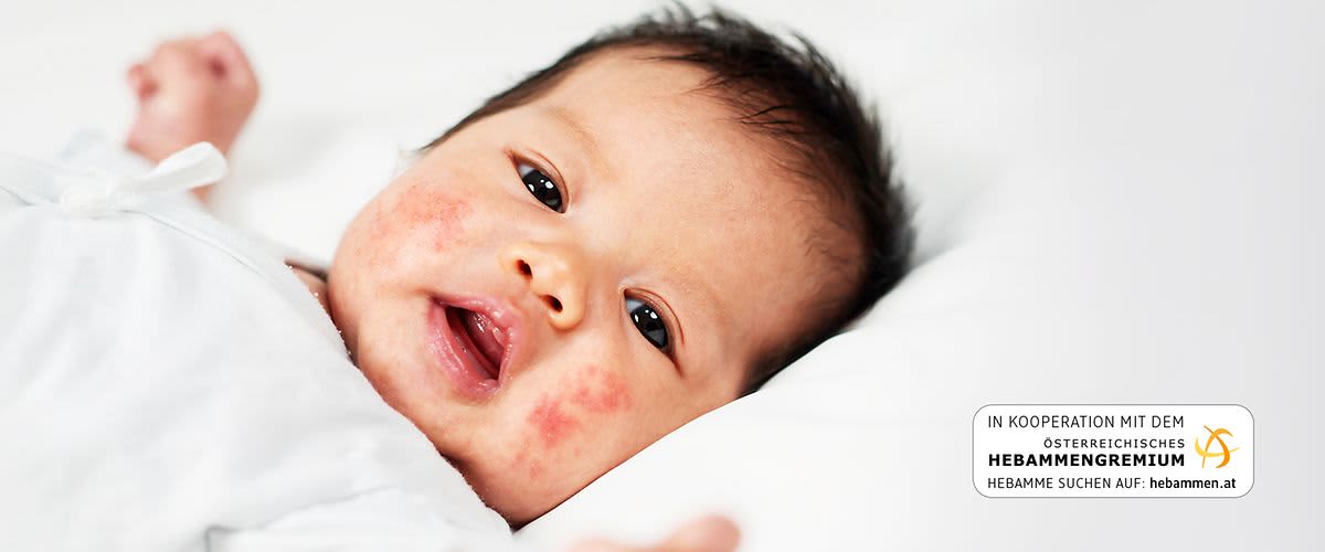Baby mit roten Flecken im Gesicht