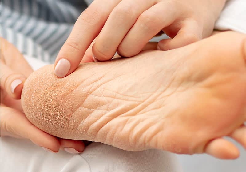 Ein Fuß mit Hornhaut