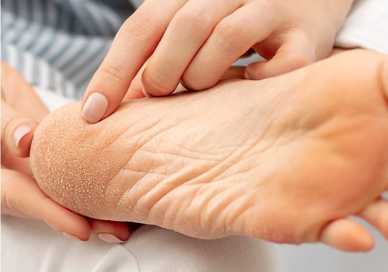 Ein Fuß mit Hornhaut