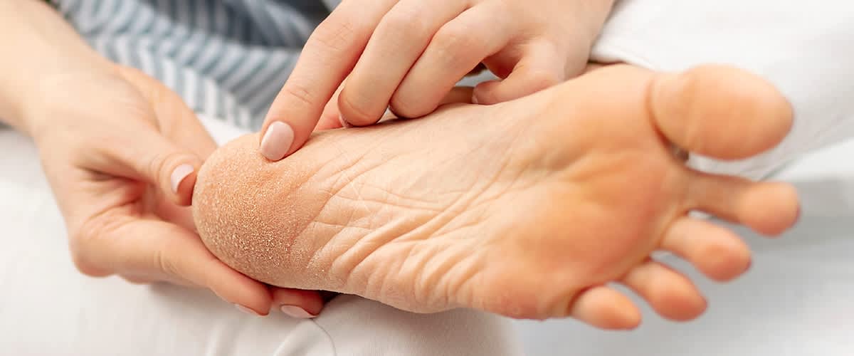 Ein Fuß mit Hornhaut