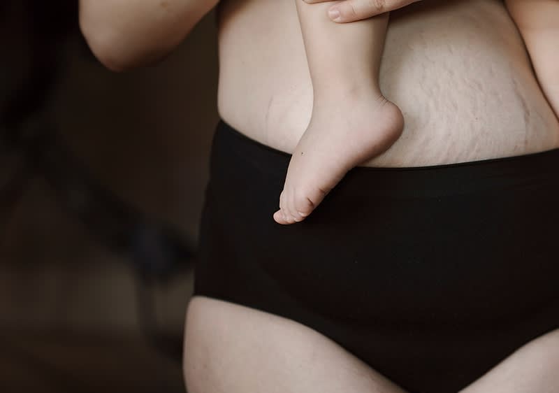 Bauch mit Schwangerschaftsstreifen