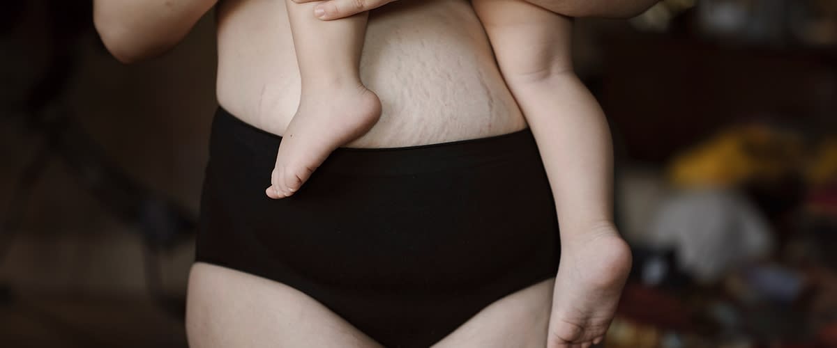 Bauch mit Schwangerschaftsstreifen
