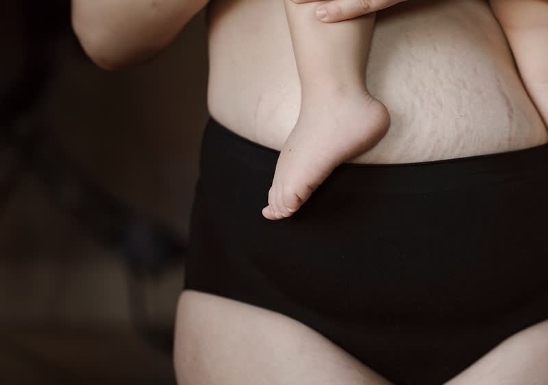 Bauch mit Schwangerschaftsstreifen