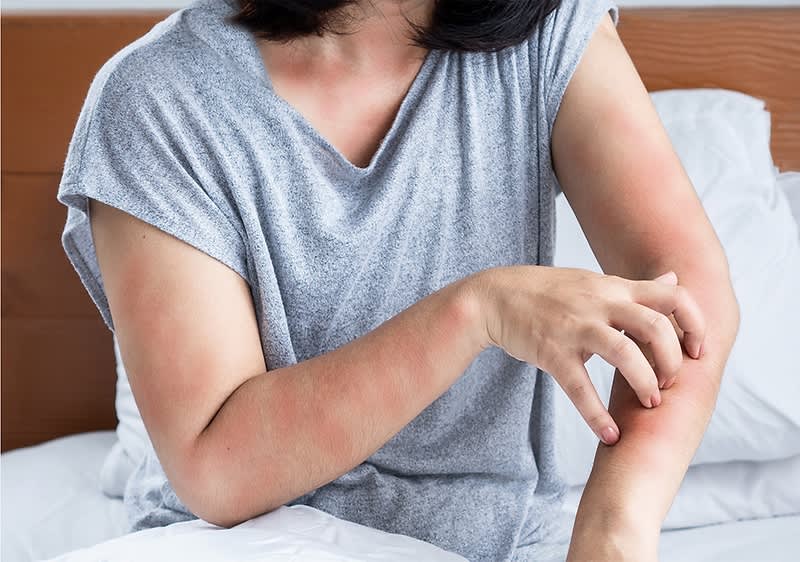 Frau kratzt sich am Arm im Bett