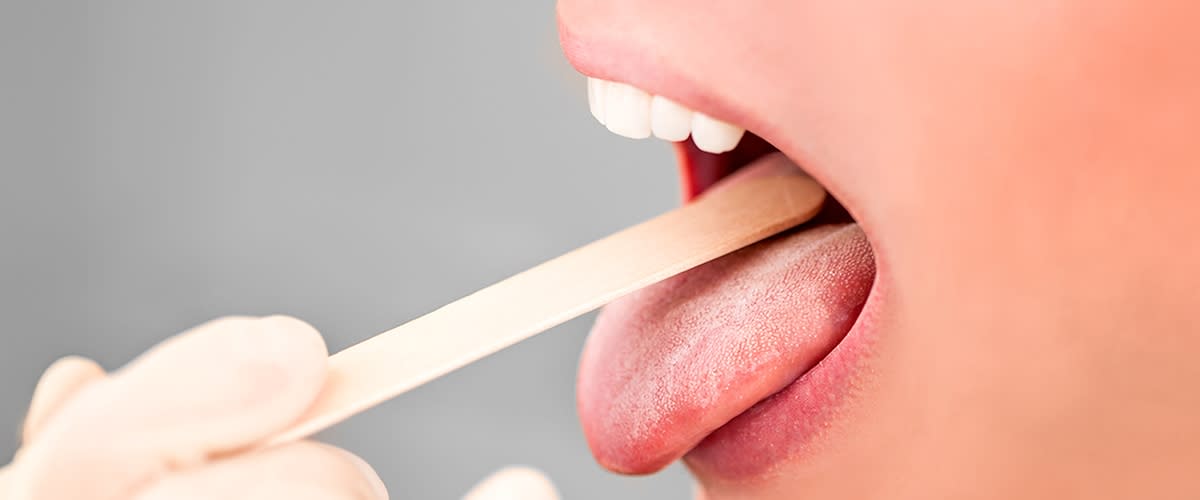 Munduntersuchung mit Zungenspatel und geöffnetem Mund