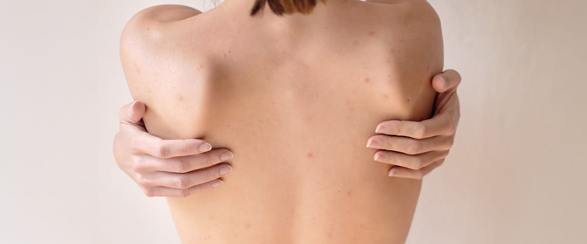 Pickel auf Rücken einer Frau mit Händen auf Schultern