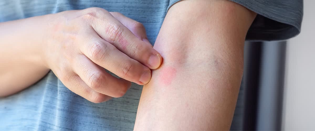 Hautirritation am Arm mit geröteter Stelle und Hand die kratzt