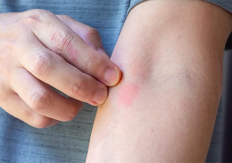 Hautirritation am Arm mit geröteter Stelle und Hand die kratzt