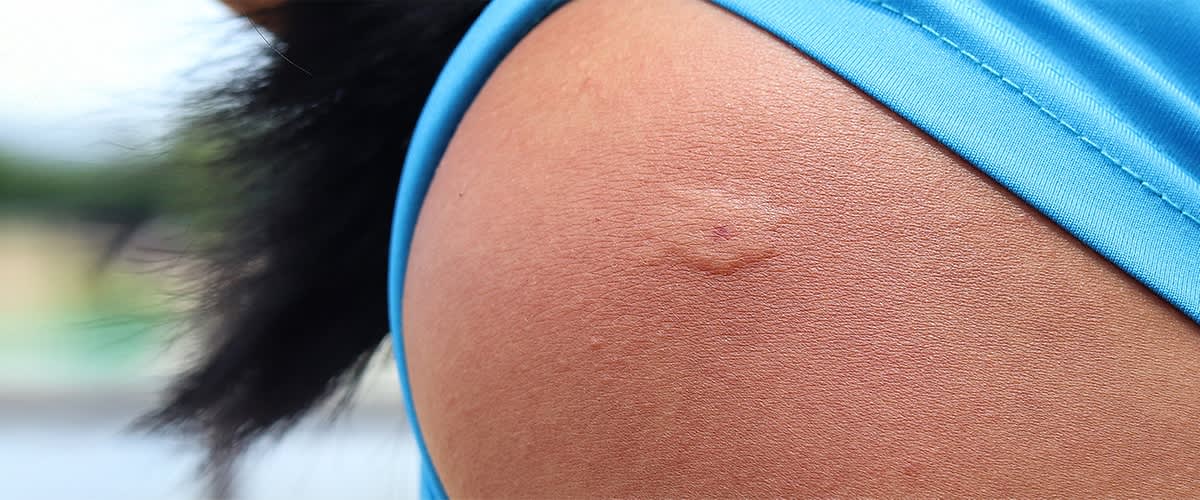 Hornissenstich auf Haut in Nahaufnahme