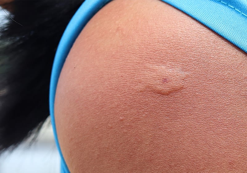 Hornissenstich auf Haut in Nahaufnahme