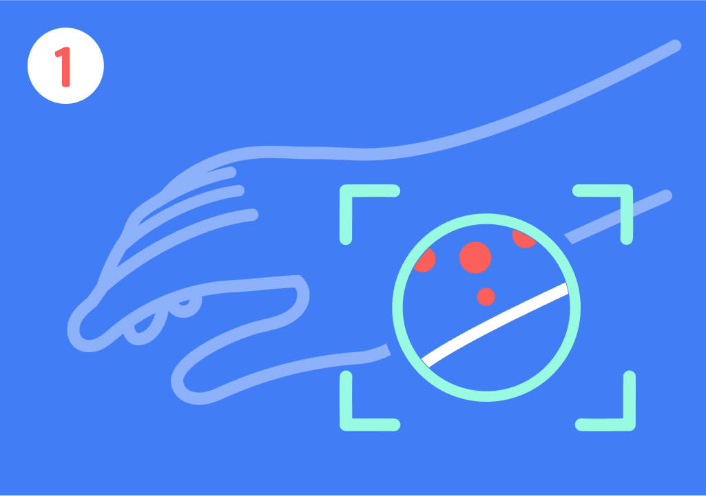 Eine Illustration zeigt eine stilisierte Hand auf blauem Hintergrund, mit einem vergrößerten Kreis, der rote Punkte und eine weiße Linie auf der Haut darstellt, oben links befindet sich eine weiße Nummer 1 in einem roten Kreis.