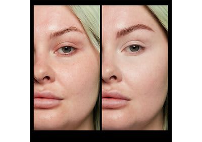 Vorher Nachher Vergleich der Haut