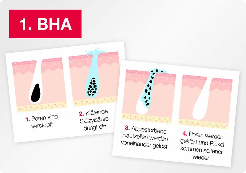 Die in den Neutrogena® Anti-Pickel+ Produkten enthaltene Beta-Hydroxy-Säure klärt Talg, der in den Poren eingeschlossenen ist.