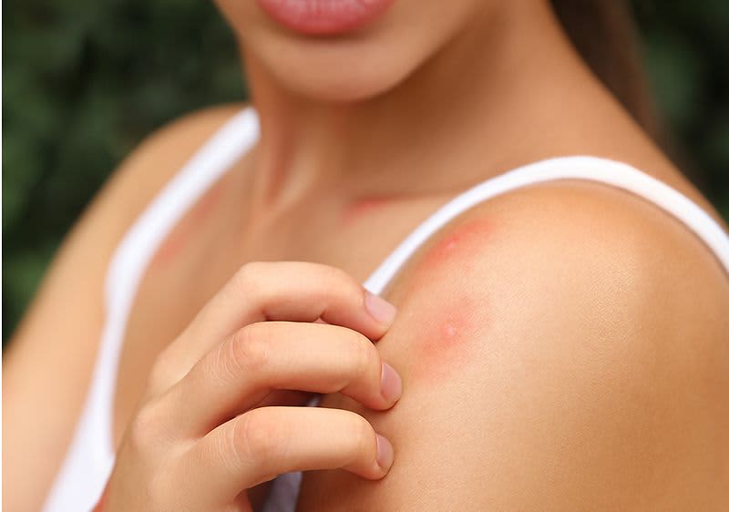 Hausmittel gegen Mueckenstiche