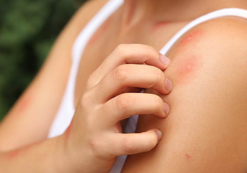 Hausmittel gegen Mückenstiche