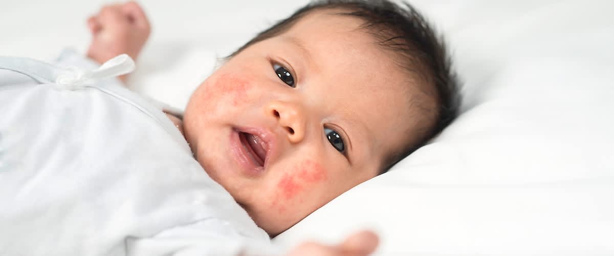 Baby mit Neurodermitis im Gesicht