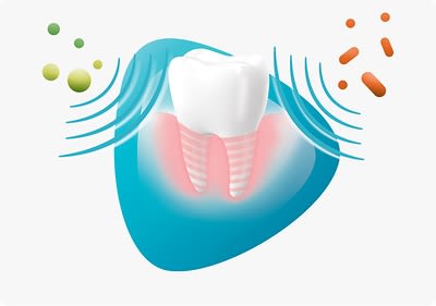 Grafik eines Zahns mit Schallwellen
