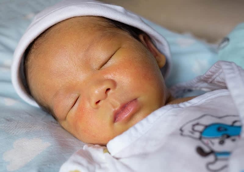 Neugeborenen Gelbsucht Bild