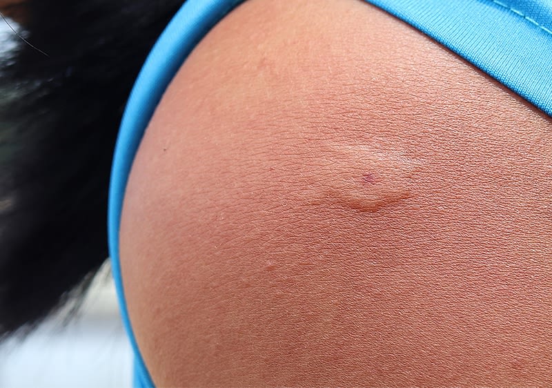 Eine Nahaufnahme einer Haut mit einem kleinen, runden Narbengewebe auf der Schulter, umgeben von einem blauen Kleidungsstück