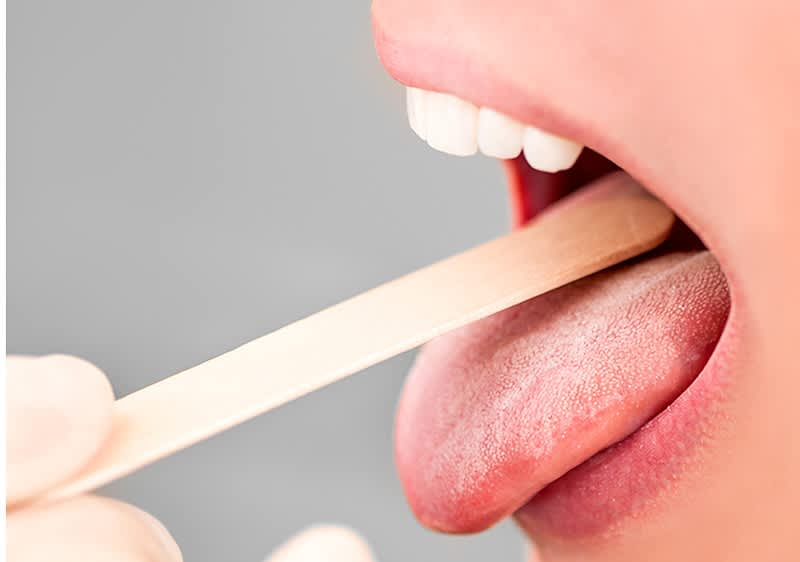 Munduntersuchung mit Zungenspatel und geöffnetem Mund