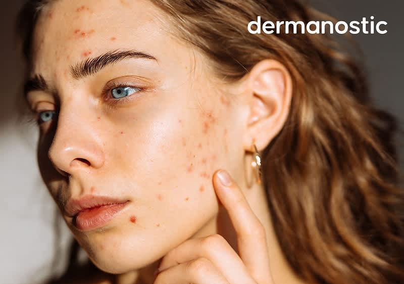 Eine Frau mit Akne im Halbprofil