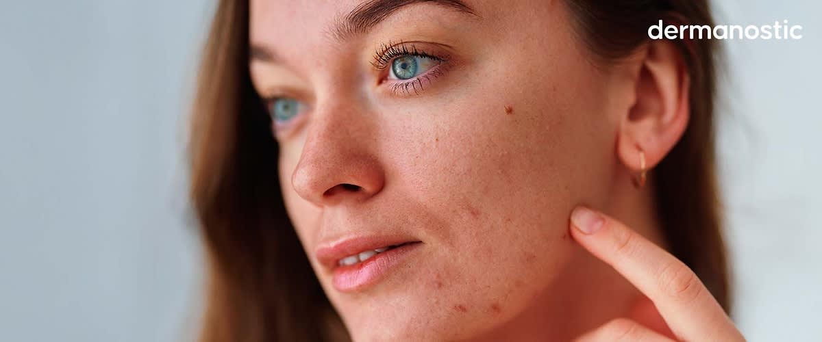 Frau mit Ausschlag im Gesicht