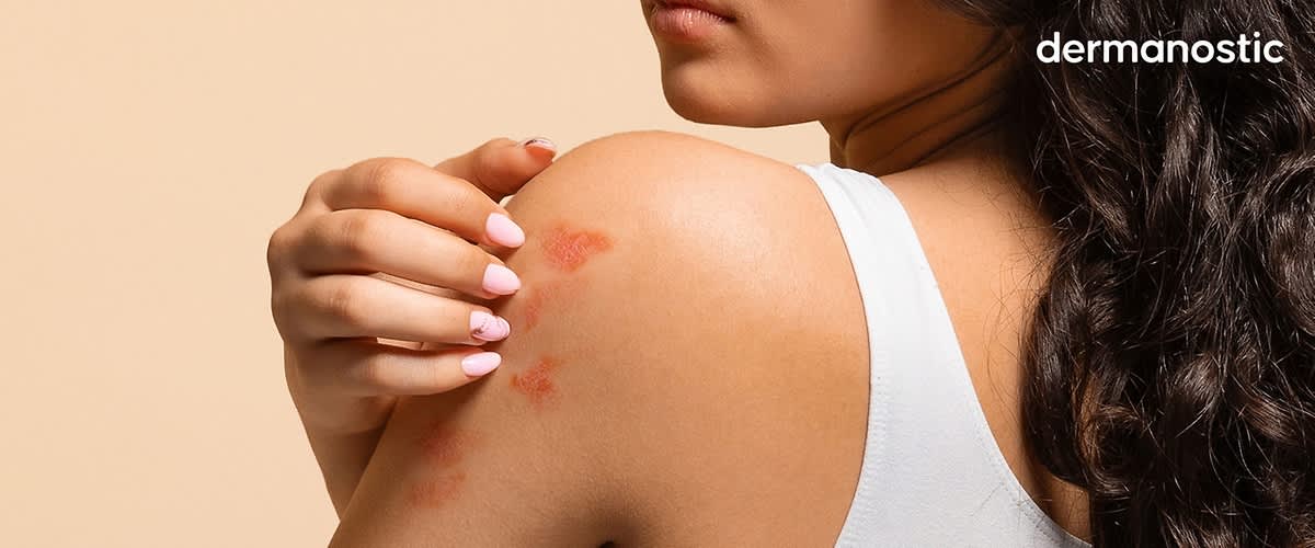 Weiblicher Rücken mit Neurodermitis