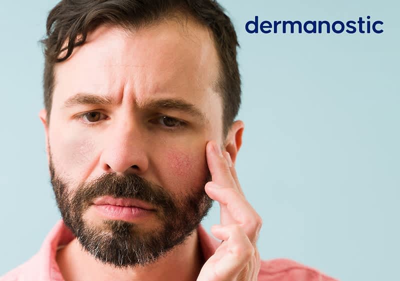 Mann mit Couperose berührt sein Gesicht