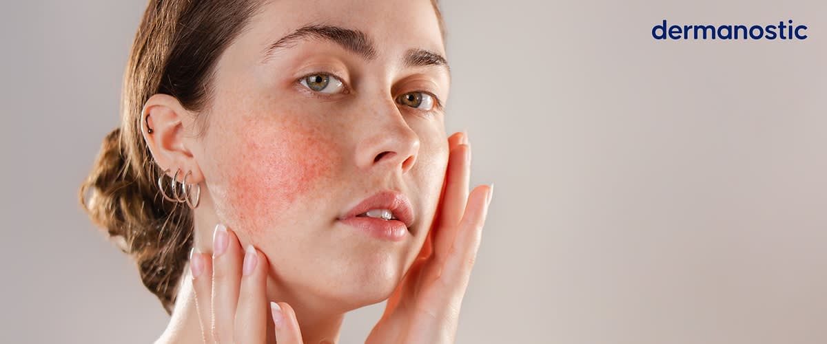 Gesicht einer Frau mit Rosacea