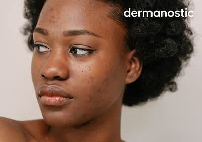 Frau mit hormoneller Akne im Seitenprofil