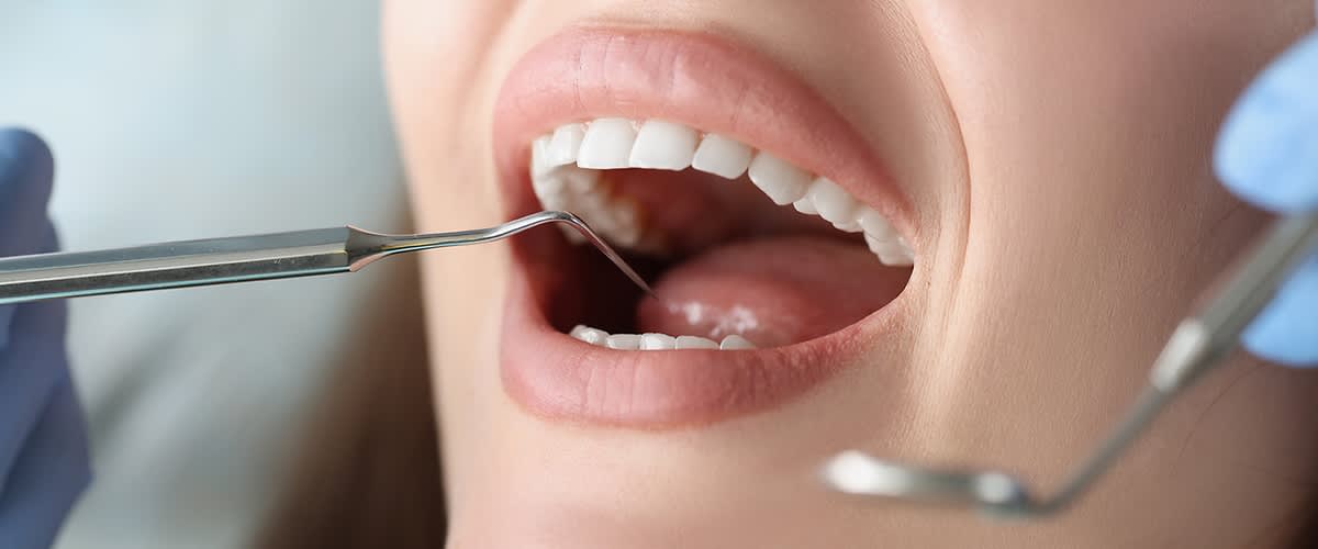 Nahaufnahme eines geöffneten Mundes während einer zahnärztlichen Untersuchung mit einem Dentalinstrument