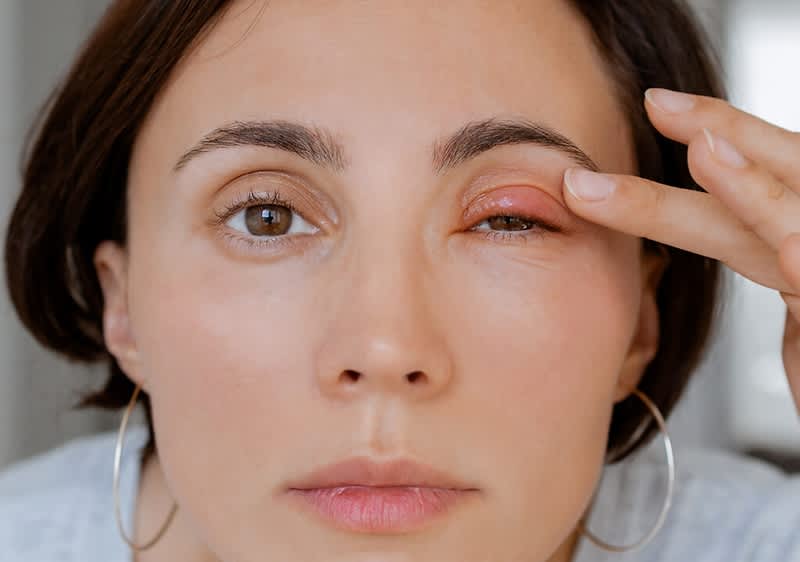 Eine schwarzhaarige Frau ist in Nahaufnahme zu sehen. Sie betastet mit der linken Hand ihr linkes Auge an dem ein Gerstenkorn zu sehen ist.