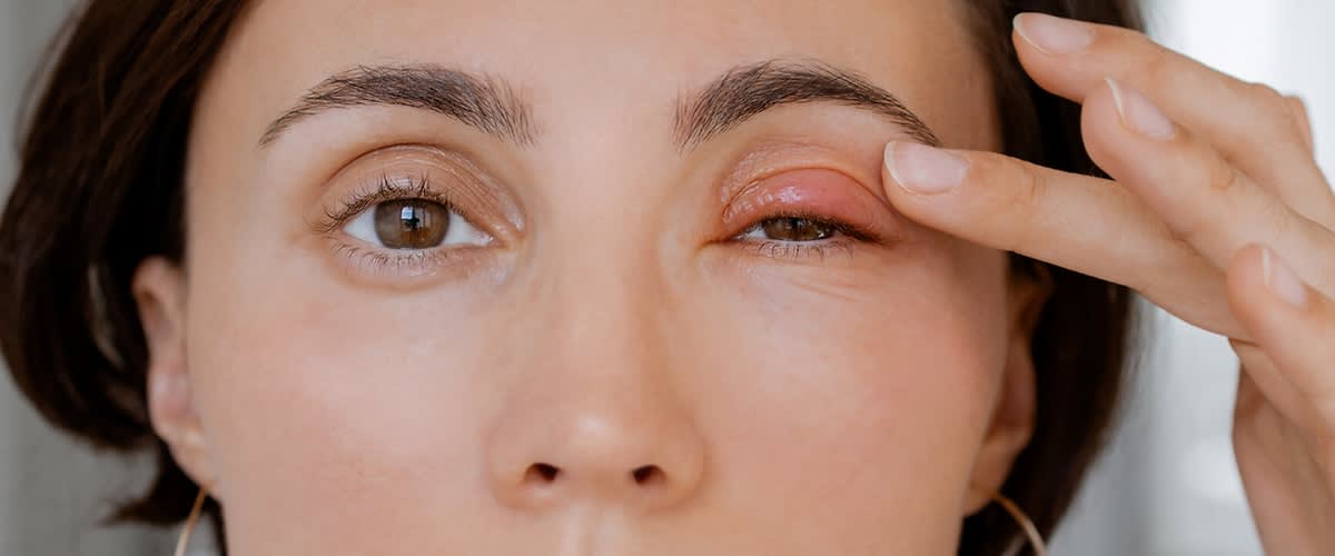 Eine schwarzhaarige Frau ist in Nahaufnahme zu sehen. Sie betastet mit der linken Hand ihr linkes Auge an dem ein Gerstenkorn zu sehen ist.