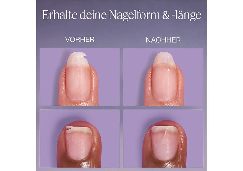 Zwei Nahaufnahmen von zwei Fingernägeln auf lila Hintergrund, links beide beschädigten Nägel mit abgebrochener Spitze, rechts beide gesunden, glatten Nägel, darüber die Beschriftungen „Vorher“ und „Nachher“