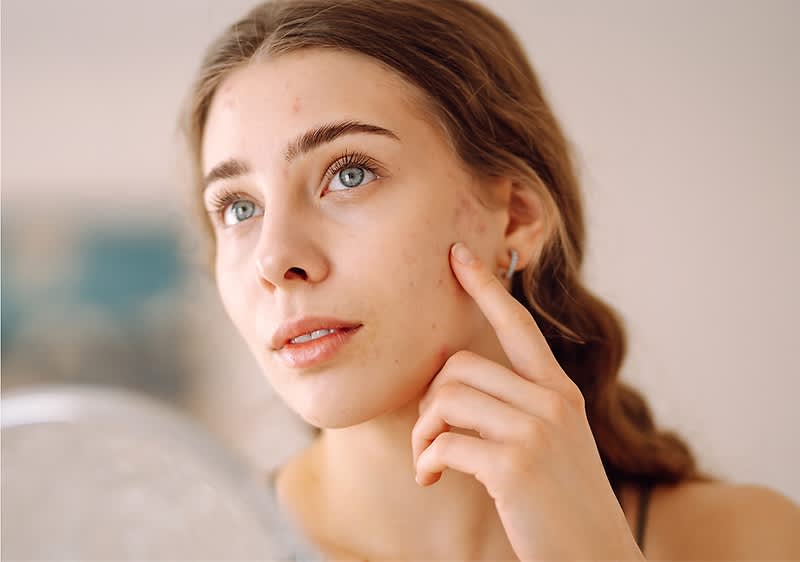 Junge Frau mit braunen Haaren und grünnen Augen zeigt mit Finger auf Pickel am Haaransatz