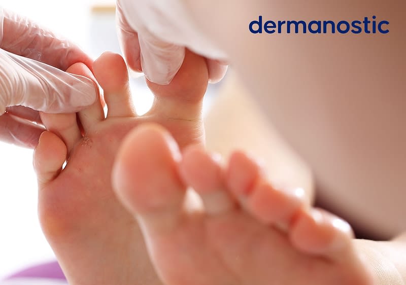 Zwei Hände in weißen Handschuhen untersuchen die Zehen eines Fußes, oben rechts der Schriftzug „dermanostic“