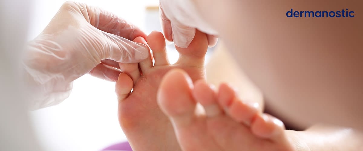 Zwei Hände in weißen Handschuhen untersuchen die Zehen eines Fußes, oben rechts der Schriftzug „dermanostic“