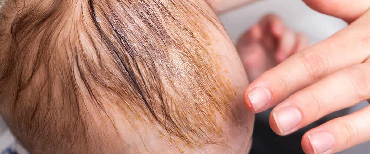 Baby in der Badewanne kratzt den Kopf - Milchschorf?