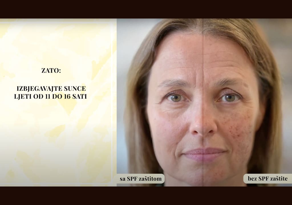 Izbjegavajte sunce ljeti od 11 do 16 h