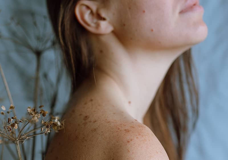 Djevojka s pjegicama po koži