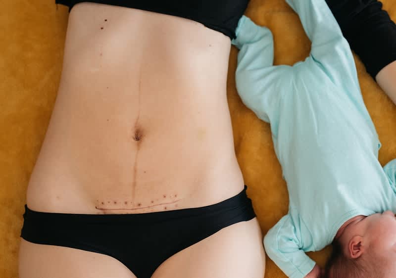 Žena s ožiljkom od carskog reza leži pored bebe