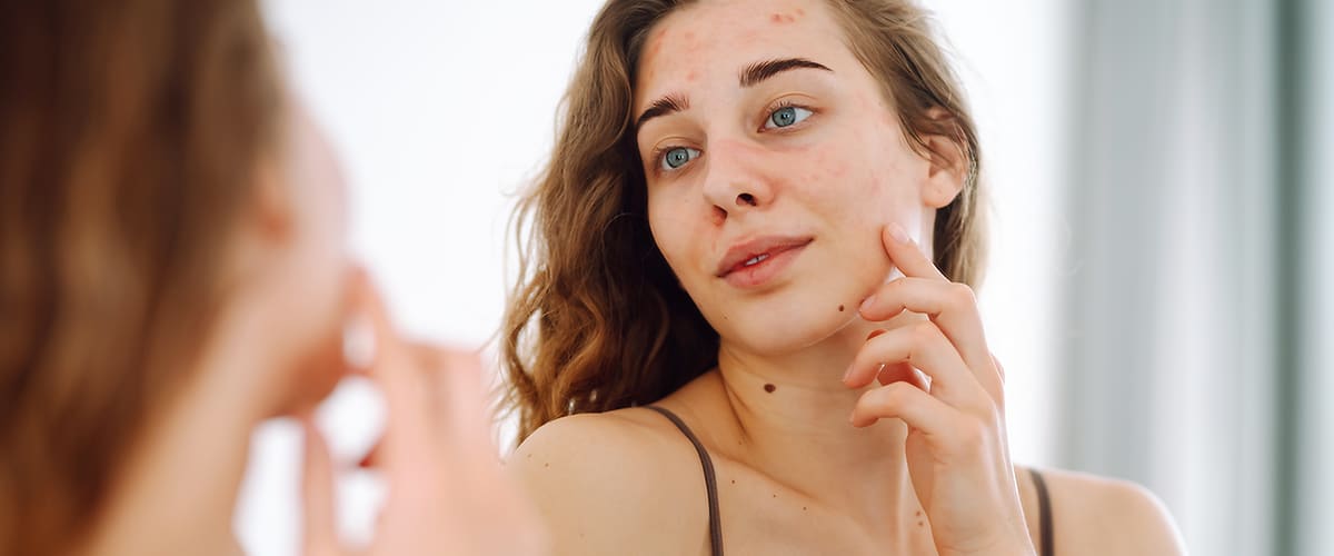 Djevojka s prištićima po licu