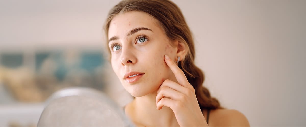 djevojka koja ima prištiće na području zulufa