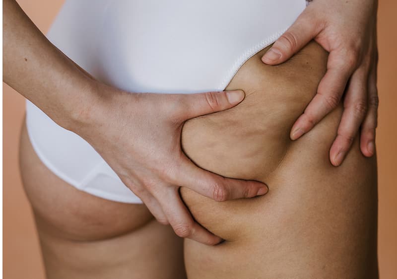 Cellulite