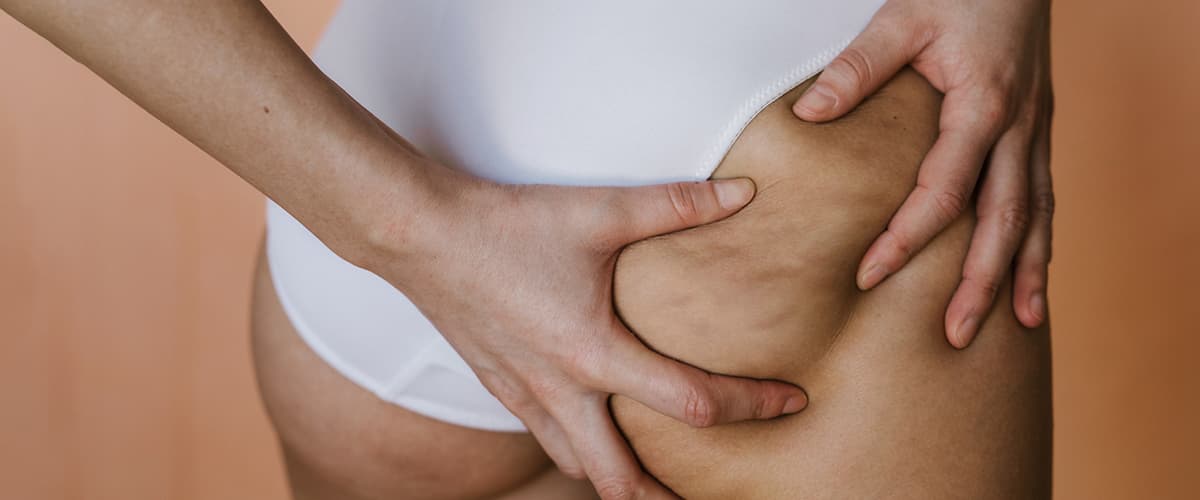Cellulite