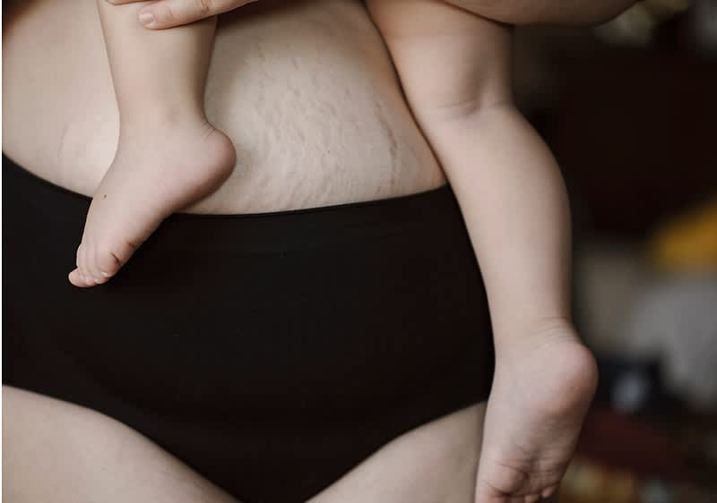 Smagliature in gravidanza