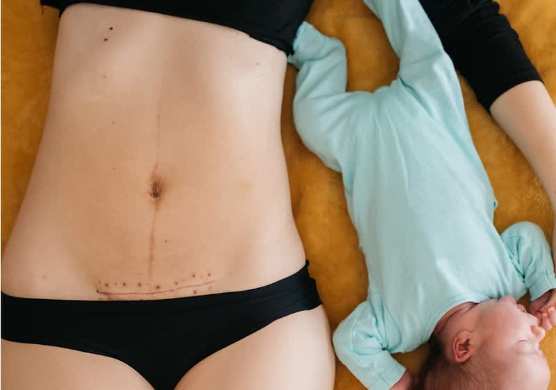 donna con cicatrice da cesareo distesa con bebè