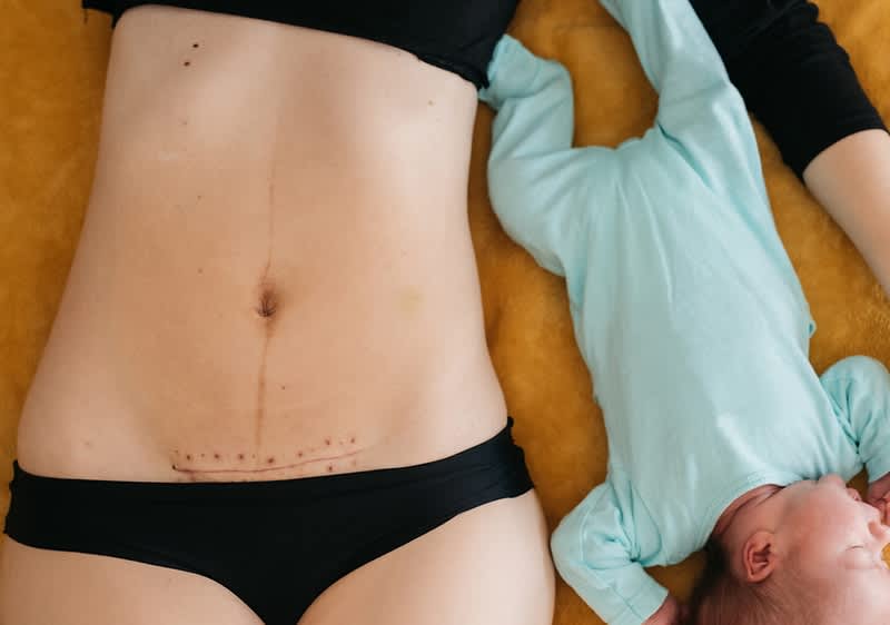 donna con cicatrice da cesareo distesa con bebè